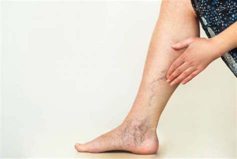 как да масажирате краката с разширени вени
